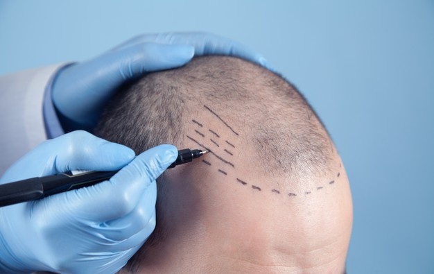 patient-suffering-from-hair-loss-consultation-with-doctor-doctor-using-skin-marker_220873-4514