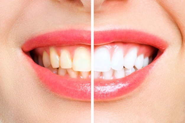 woman-teeth-before-after-whitening-image-symbolizes-stomatology_168410-884